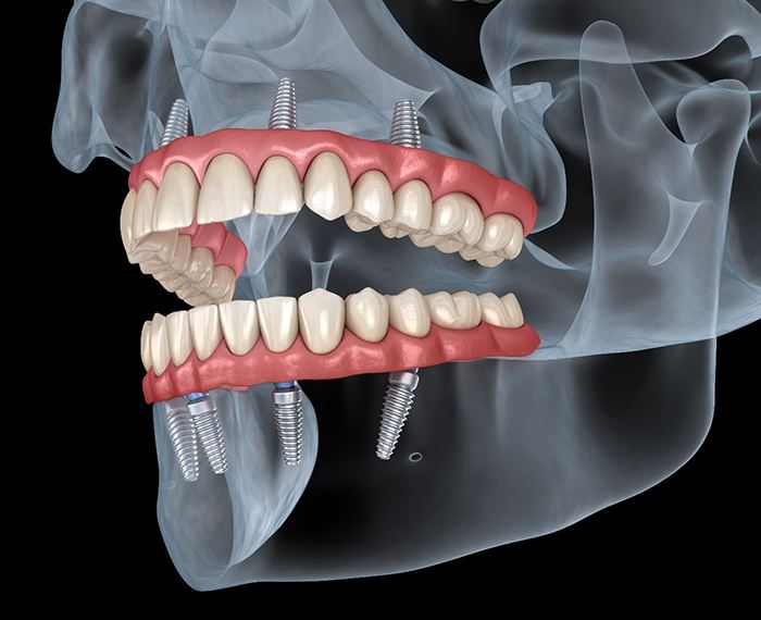 Illustration of All on 4 dental implants in Gilbert in the upper and lower arches
