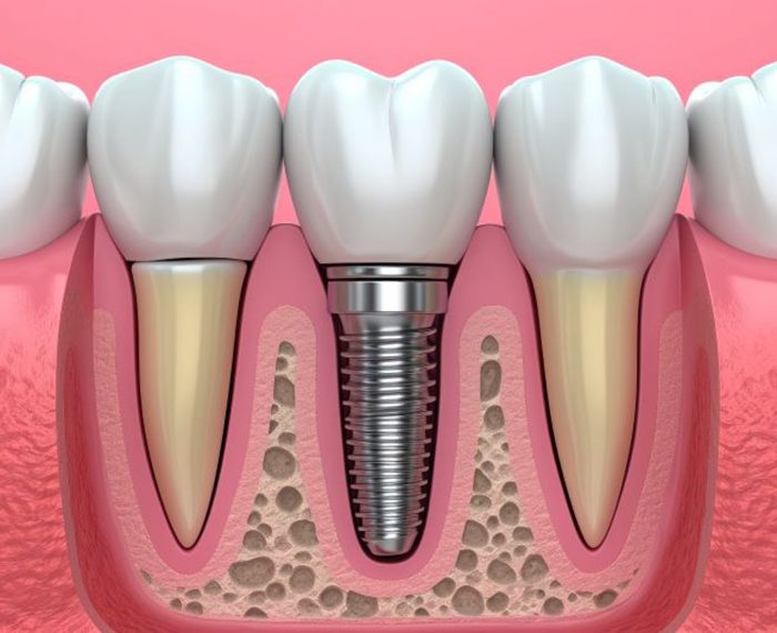 Traditional dental implant between natural teeth