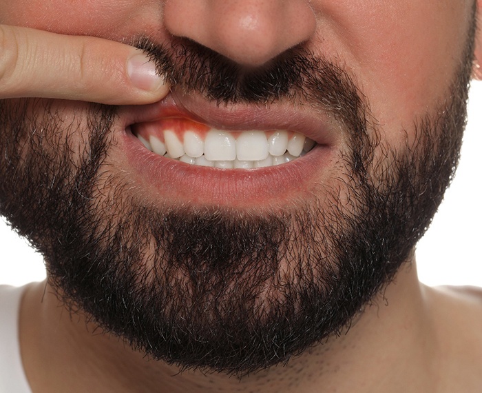 Close up of a man with inflamed gum tissue after dental implant failure