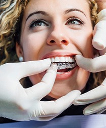 Dentist placing clear aligners over woman’s upper arch