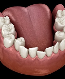 Illustration of crowded teeth