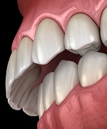 Illustration of overbite